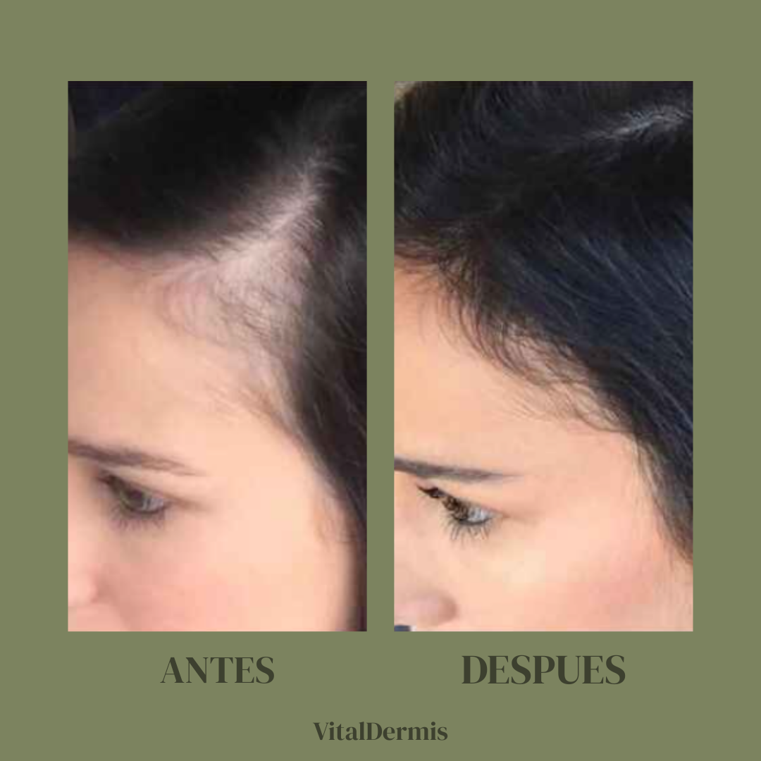 VitalDeLuxe-Suero de lujo para el crecimiento del cabello