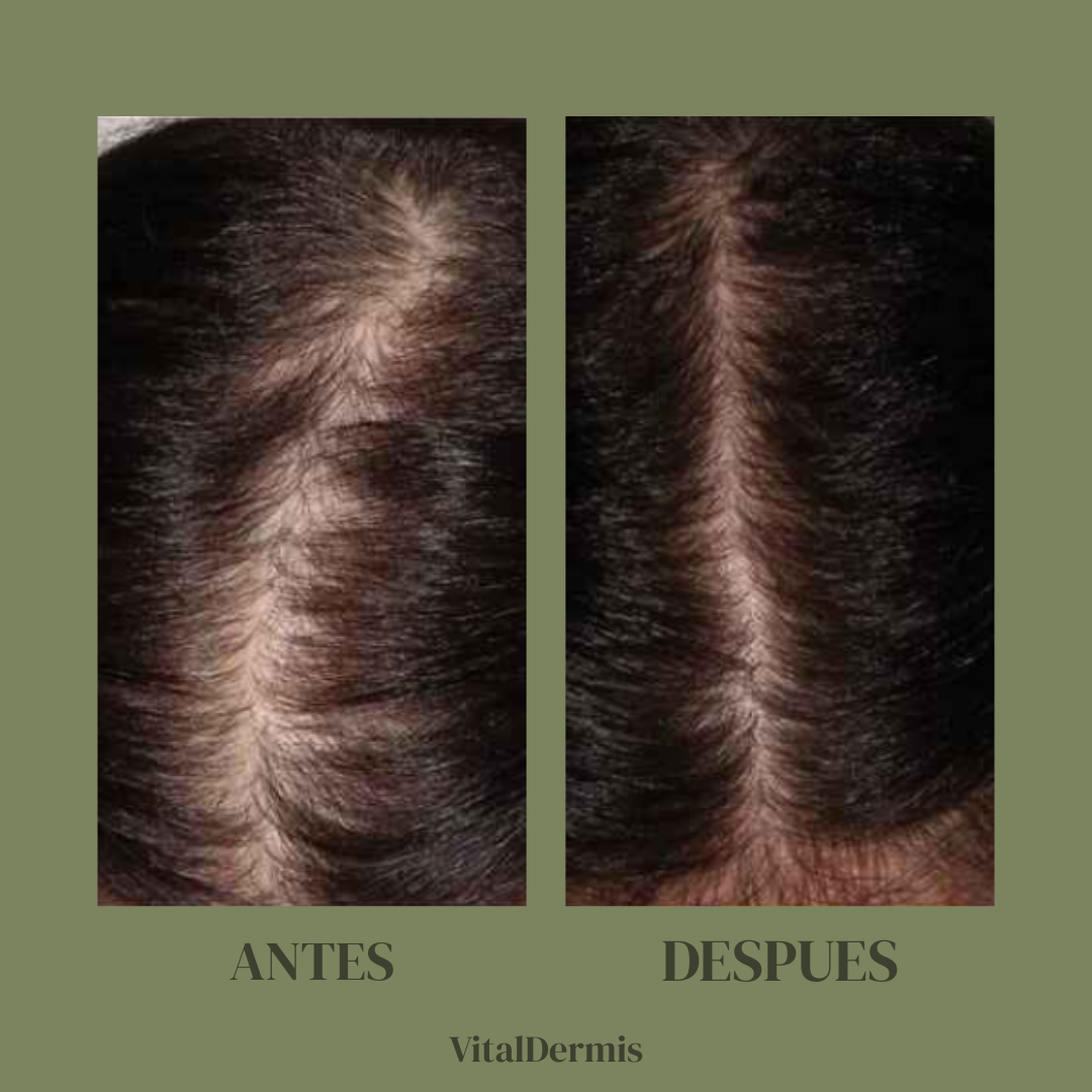 VitalDeLuxe-Suero de lujo para el crecimiento del cabello